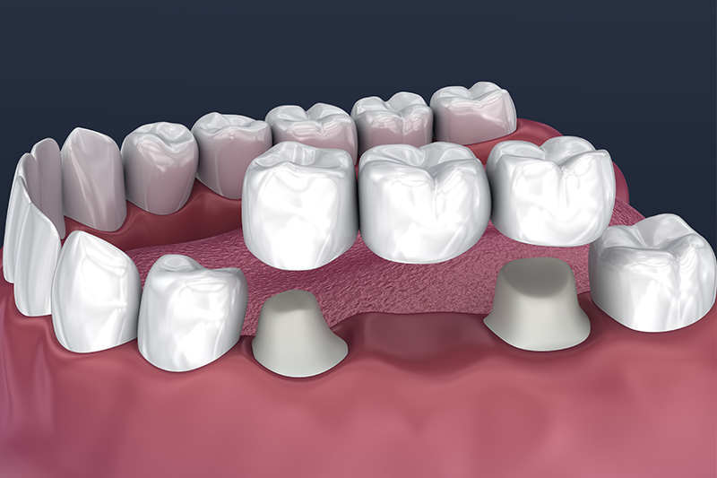 Crowns and Bridges, Inlays and Onlays  - Galleria Dental, Mundelein Dentist